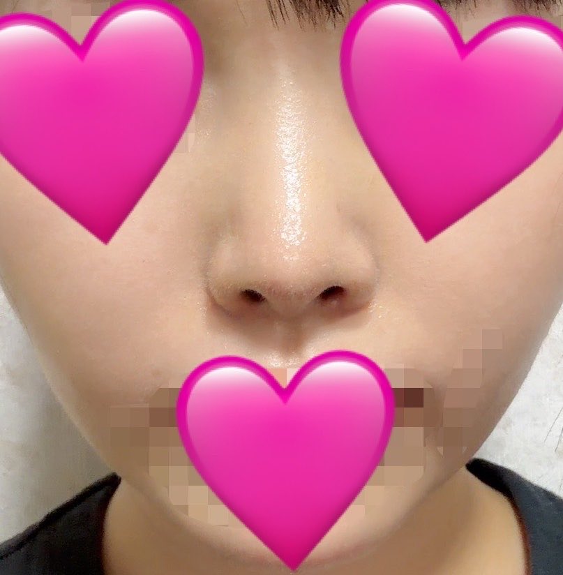 5hJfb's tweet photo. 鼻整形をしてから9ヶ月が経過しました😌
1枚目：整形前
2枚目：術後1ヶ月
3枚目：術後9ヶ月

最近は鼻整形したことを忘れてしまうくらい自然に馴染んでるけど、こうやって術前と並べて見ると結構変わったな〜と改めて感じてます🥹✨ https://t.co/yXTVbmCKDI