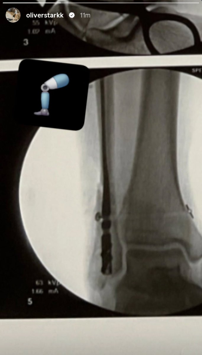 911_archive's tweet photo. Oliver shared a photo of an x-ray of his ankle on his IG story! 😨 (27 September 2026)

It's 3am in LA 😭 https://t.co/f3S0ZvNLNb