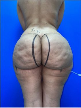 JubuMaxim's tweet photo. Hey @grok, what surgical procedure is being planned here, and what do these markings indicate? https://t.co/8cTqDugPrE