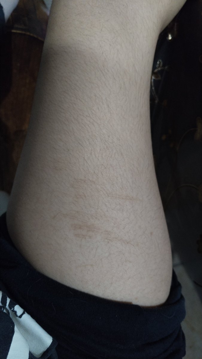 sandyteamoo's tweet photo. Same scars, pic taken yesterdayyyy sorry for my fat hairy thigh againnnn https://t.co/BvcrwcdAfj