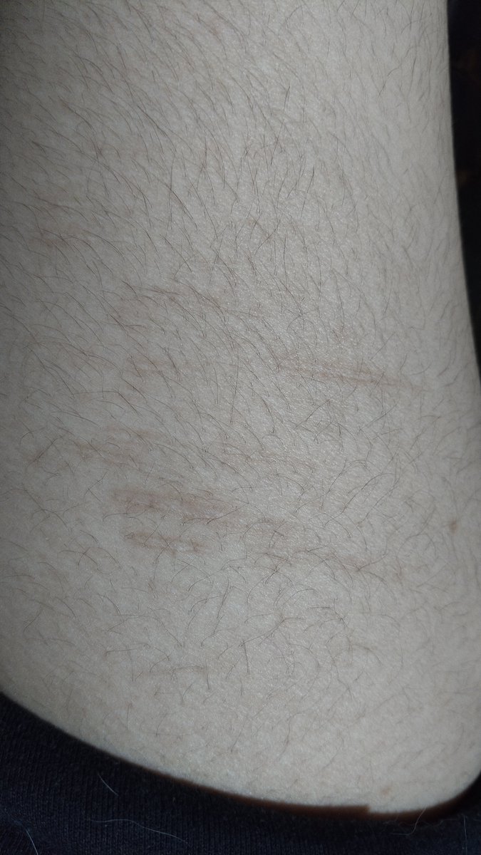sandyteamoo's tweet photo. Same scars, pic taken yesterdayyyy sorry for my fat hairy thigh againnnn https://t.co/BvcrwcdAfj