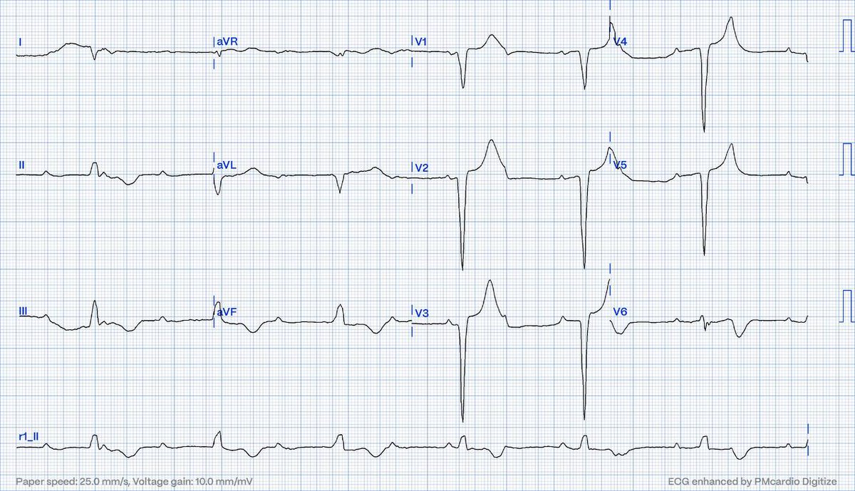EcgOxford's tweet photo. Rhythm?
@akneton @yolyabreuh @UlhasDr
@DidlakeDW @ecgrhythms @IhabFathiSulima
@DrPharmDMDTh @Vadeboncoeur_Al @smithECGBlog
@EM_RESUS @estudiomedicina @OrlandoRPN @fxgodzeuss #EPeeps #FOAMcc @ResusMed @TrRja @NaokiThukishima @ecgandrhythmRoe https://t.co/0i8NBNUy6y