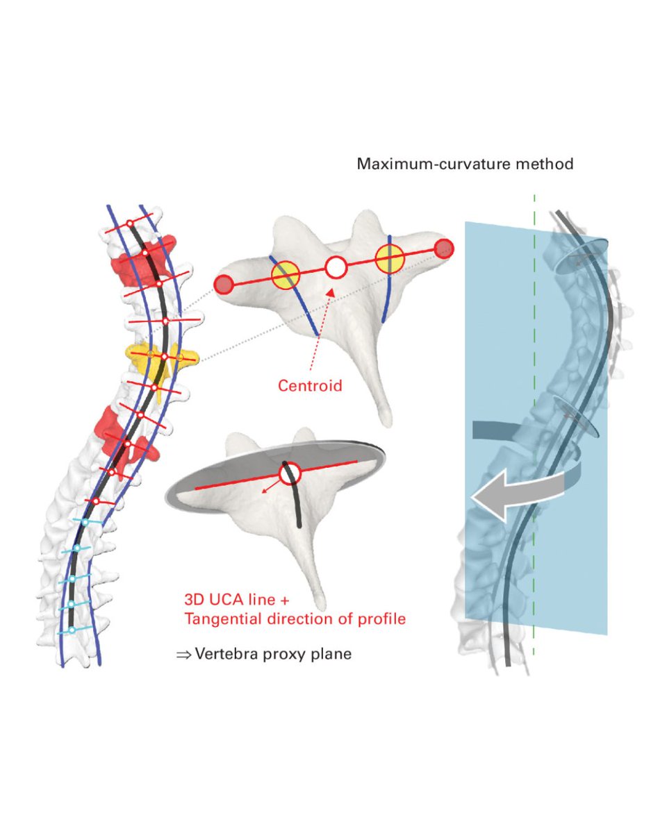 BoneJointJ's tweet photo. The plane of maximum curvature, measured using 3D reconstructions of the spine, offers accurate 3D representation, but the optimal method of measuring the plane of maximum curvature remains unknown.

#Spine #Scoliosis #Orthopedics #Surgery

https://t.co/7SaqXLeV6x https://t.co/9y5Vt0n67O