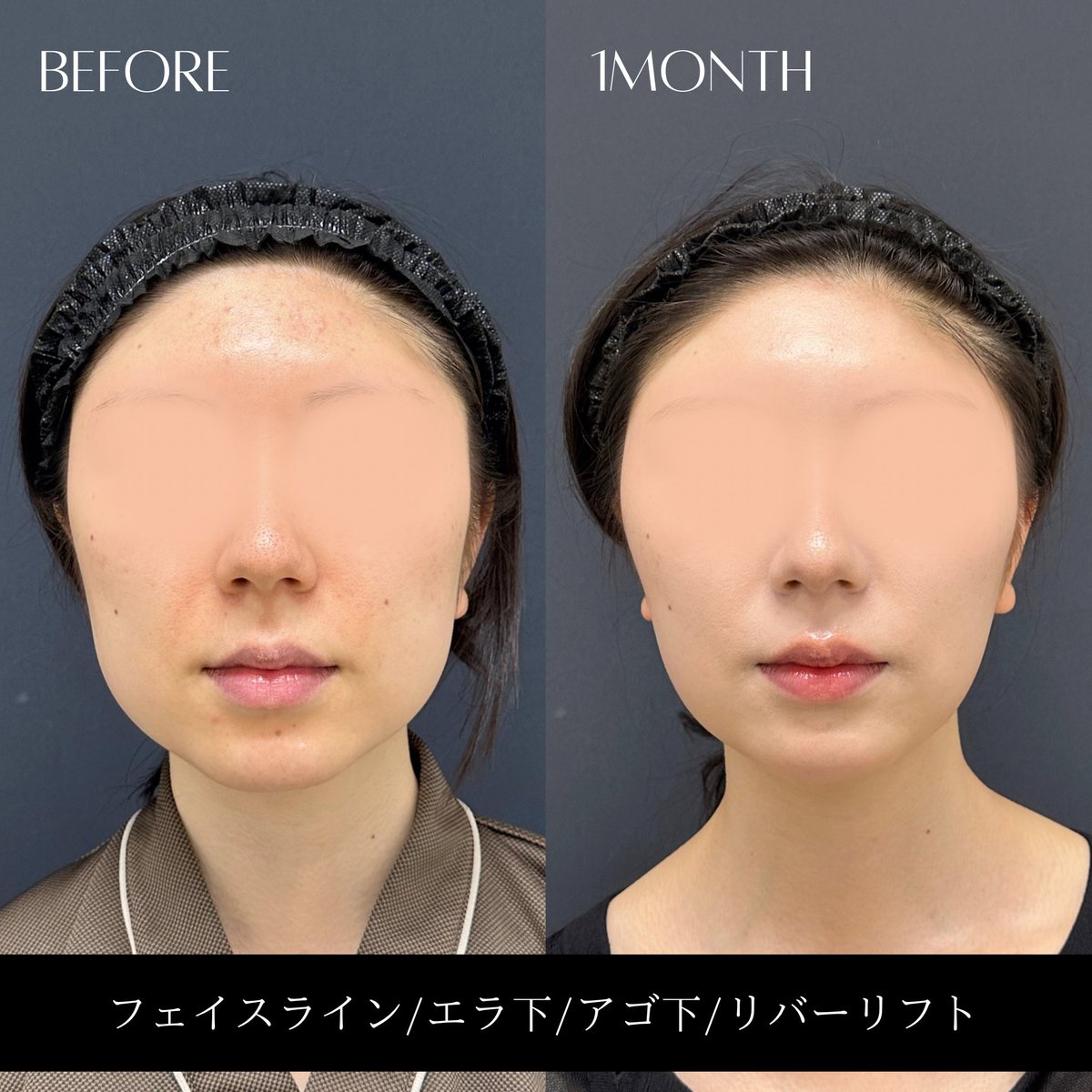 _RIVERCLINIC's tweet photo. 「顔の脂肪吸引って、本当に変わるんですか？」
→ 術後1ヶ月です。

フェイスライン／エラ下／アゴ下＋リバーリフト。

顔の脂肪吸引は、ただ脂肪をたくさん取ればいい手術ではありません。

どこの脂肪を取って、どこの脂肪を残すか。
顔全体のバランスを見ながら、その人に合った輪郭をつくる。

美容外科医として5年以上、顔の脂肪吸引関連5,000件以上。
今でも一症例ずつ「もっと綺麗にできないか」を考えながら手術しています。

リバー式小顔脂肪吸引は
固定バンド不要・翌日からメイクOK。

派手なことを言うより、症例で見てもらえたら嬉しいです。

リバークリニック　理事長　戸田貴之