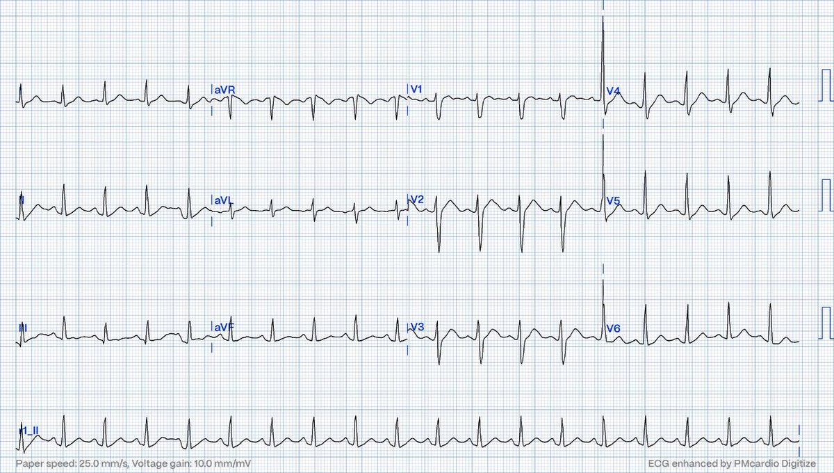 EcgOxford's tweet photo. SOB
Ctnl 0.8 mg/dl
Dx?
@akneton @yolyabreuh @UlhasDr
@DidlakeDW @ecgrhythms @IhabFathiSulima
@DrPharmDMDTh @Vadeboncoeur_Al @smithECGBlog
@EM_RESUS @estudiomedicina @OrlandoRPN @fxgodzeuss #EPeeps #FOAMcc @ResusMed @TrRja @NaokiThukishima @ecgandrhythmRoe https://t.co/PMuzTO4njb