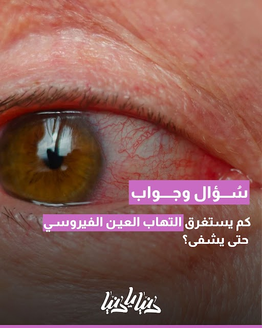 كم يحتاج التهاب العين الفيروسي للتعافي؟.. ومتى يستدعي القلق؟. المزيد 
