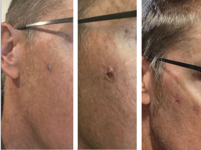 Dr_devd's tweet photo. 🧴 FENBENDAZOLE PASTE + BASAL CELL CARCINOMA: A PATIENT’S BEFORE-AND-AFTER STORY

A Canadian patient shared photographs documenting what he described as a biopsy-confirmed basal cell carcinoma on his right cheek. According to his account, the lesion had been present for months while he waited for dermatology care.

He says he began applying veterinary fenbendazole paste directly to the lesion. The photographs reportedly show changes over the following weeks, with the scab becoming smaller and the visible surface appearing substantially improved after roughly two months.

WHAT MAKES THIS CASE INTERESTING

• The patient reports a previous BCC diagnosis
• Fenbendazole paste was applied topically
• Visible changes were documented with photographs
• He still attended dermatology follow-up
• Removal of the lesion was reportedly still planned

The final point is particularly important. A skin lesion becoming smaller or disappearing visually does not confirm that basal cell carcinoma has been eliminated beneath the skin. Only appropriate medical assessment and, when indicated, pathology can establish whether malignant cells remain.

Fenbendazole has attracted attention in experimental cancer research, but veterinary fenbendazole paste is not an established treatment for basal cell carcinoma. This remains an individual testimonial rather than evidence that the treatment caused the reported improvement.

Cases like this can generate research hypotheses. Controlled studies are needed to determine whether there is a genuine therapeutic effect.

✨ Follow @Dr_devd  for more patient cases and emerging cancer research.

#Fenbendazole #BasalCellCarcinoma #SkinCancer #CancerResearch #DrugRepurposing #Dermatology #Oncology