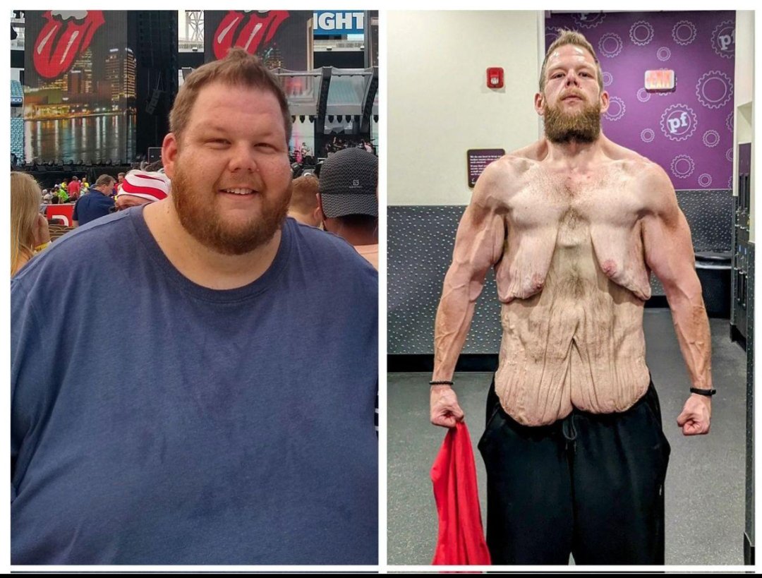 ThinkBetterNow7's tweet photo. Losing the weight is one thing.
Dealing with the loose skin afterward is a completely different battle.

Respect the transformation.

How do you think he should deal with it? https://t.co/jKREVbTfry