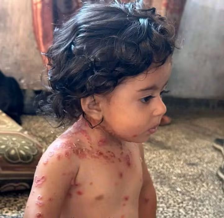 Ajmal_804's tweet photo. غزہ میں بچوں میں پھیلنے والی جلدی بیماریوں کی ایک جھلک 💔🇵🇸🇵🇸 https://t.co/4Yr6EnaqdE