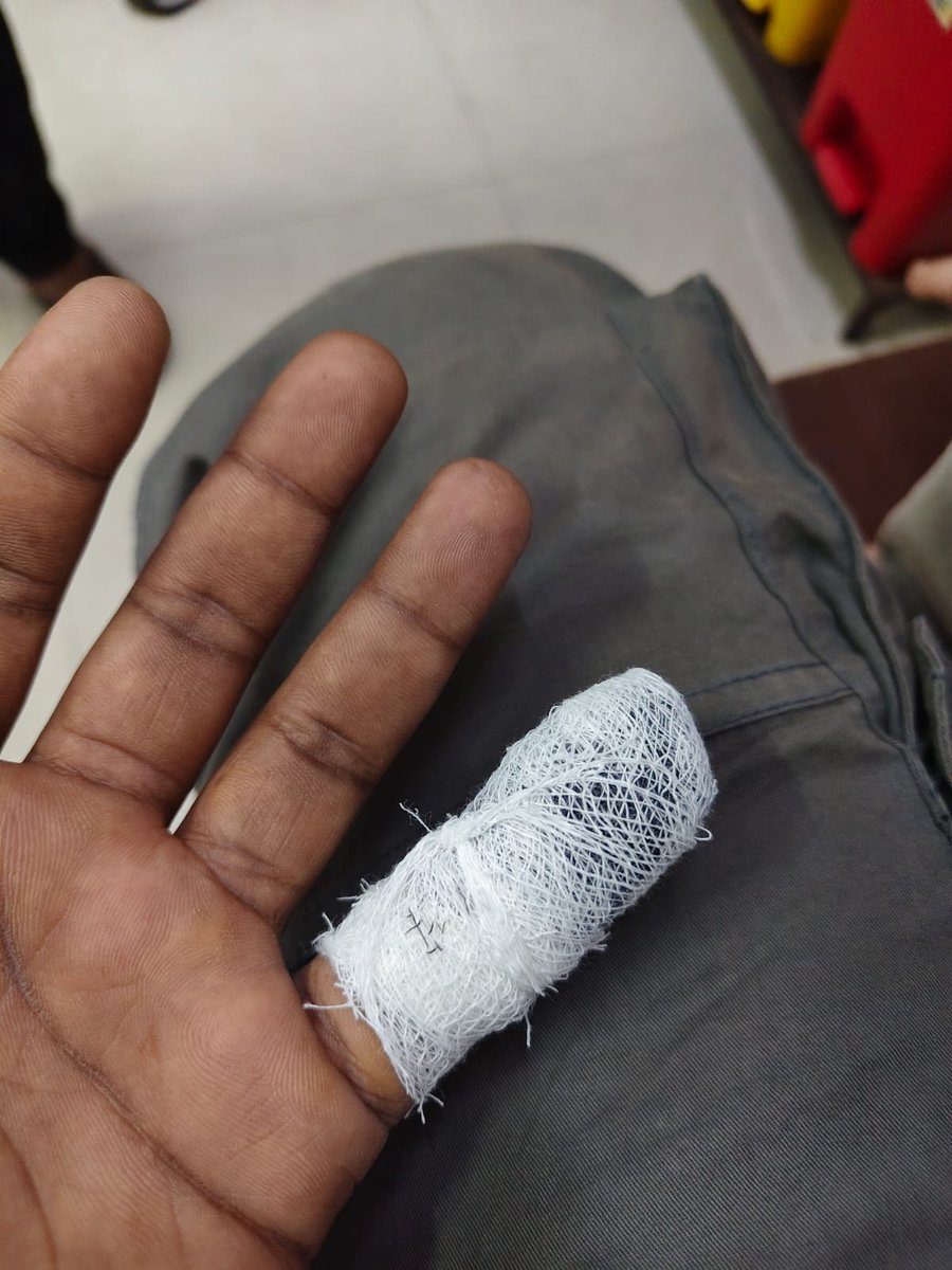 SauravK1890's tweet photo. A Union Bank employee had a monkey bite while returning from Sunday work in Uttar Pradesh.

His message: "Bhai meri branch bhi jungle me haj mujhpe bhi bandar ne attack kia. Rabies and titnus lagwa ke jaa raha. Thanks to @DFS_India ."

@idesibanda @alashshukla 

#SundayBankWork