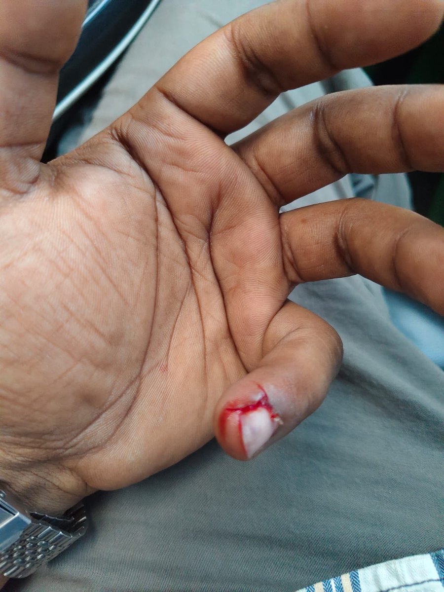 SauravK1890's tweet photo. A Union Bank employee had a monkey bite while returning from Sunday work in Uttar Pradesh.

His message: "Bhai meri branch bhi jungle me haj mujhpe bhi bandar ne attack kia. Rabies and titnus lagwa ke jaa raha. Thanks to @DFS_India ."

@idesibanda @alashshukla 

#SundayBankWork