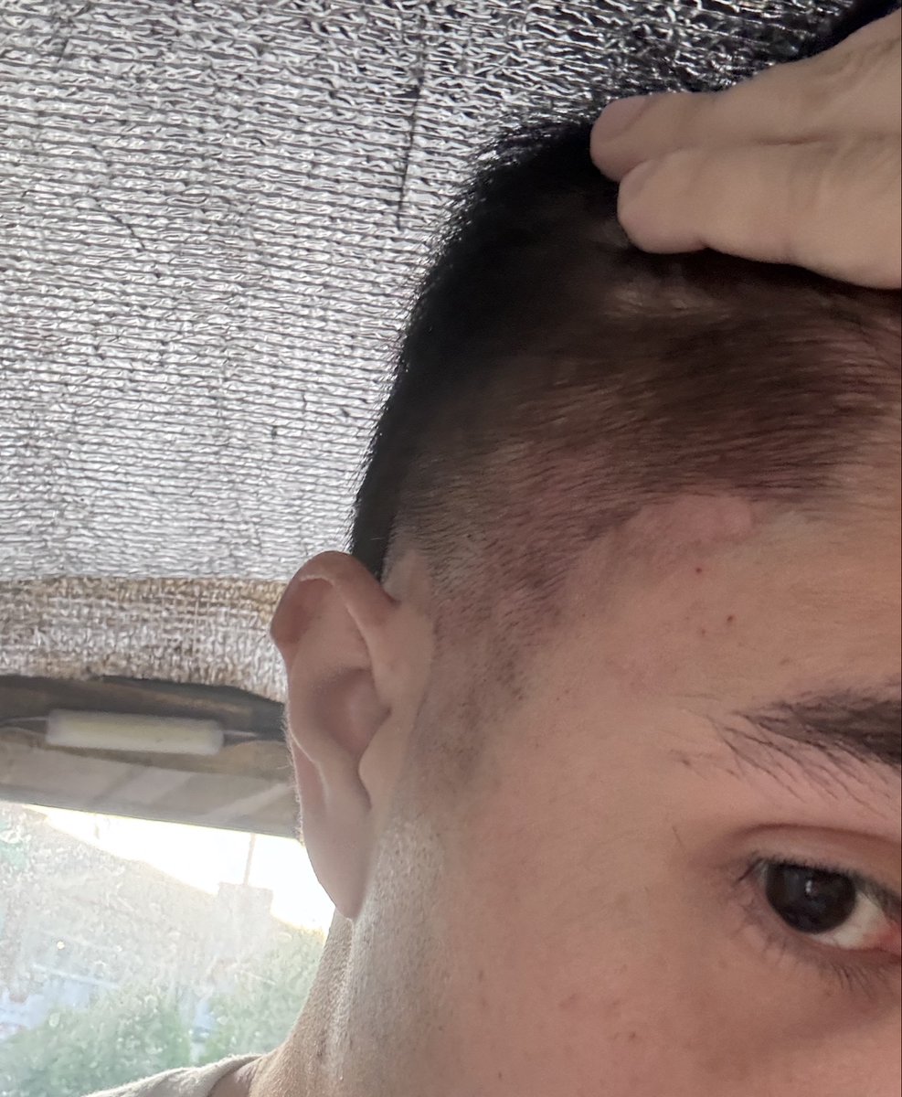sylvand0's tweet photo. As someone na may seborrheic dermatitis, hirap talaga ko magpagupit kase i dont wanna be judged like this HAHAHA. Our scalp looks inflamed with red and white patches after haircut lalo na pag stressed ako 😂 Be thankful na wala kayong skin conditions hahaha https://t.co/eWe13spNbX