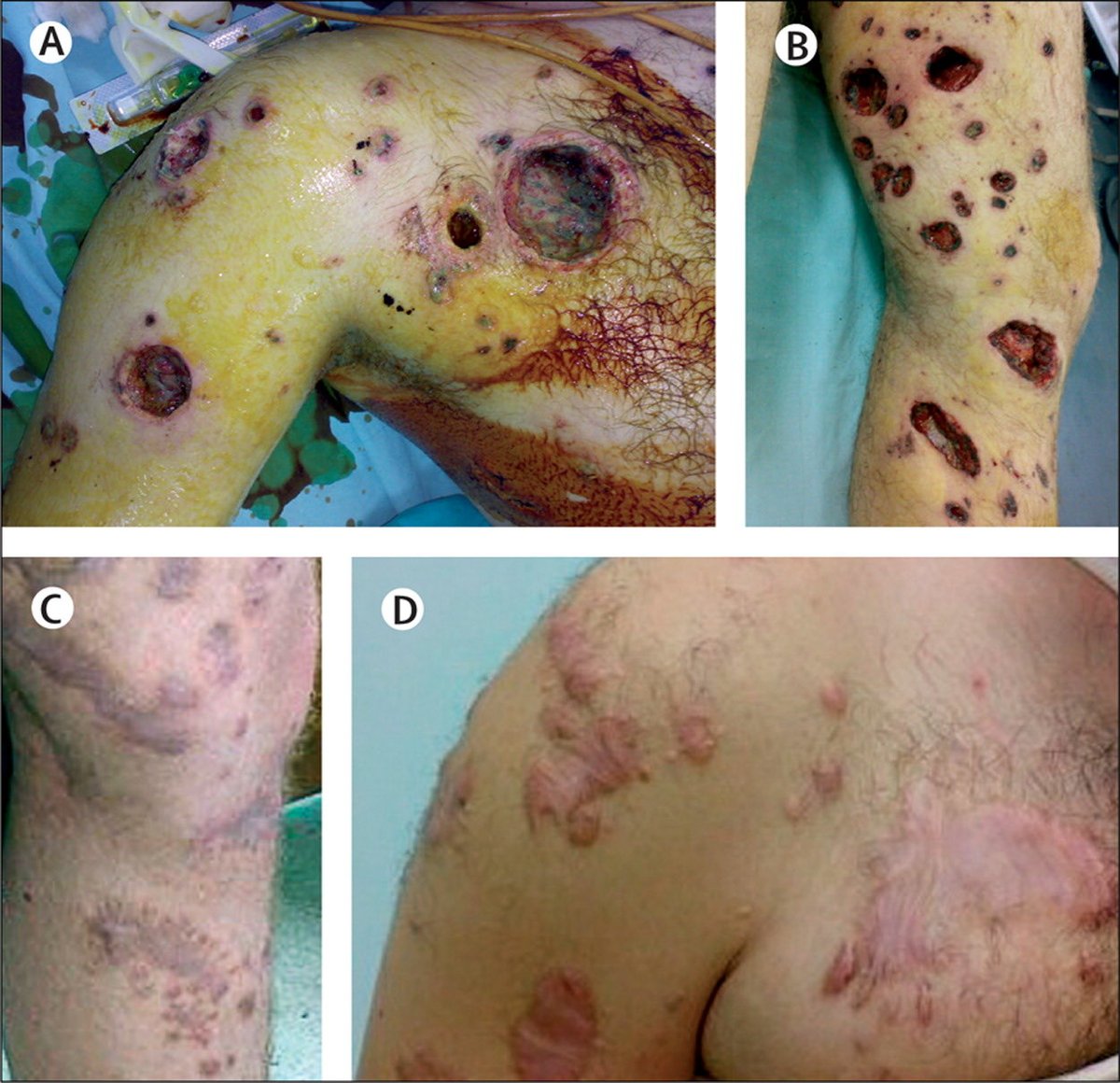 rabbimandyx's tweet photo. @RickyTheGuido @grok .@grok, describe what white phosphorus does to people. https://t.co/Szi74IvQ2a