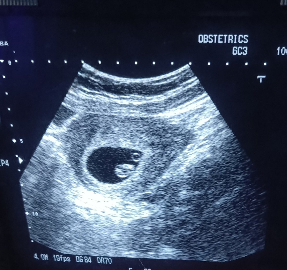 ChroRadGirlie's tweet photo. Early pregnancy. Even on Sundays? Yes. https://t.co/UYphwdVfOI