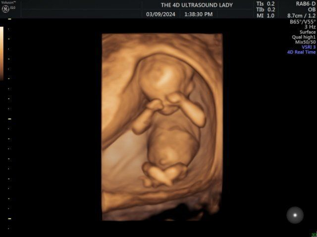 LifeNewsToo's tweet photo. Here's a tired 14 week-old unborn baby rubbing his or her eyes.   

Where's the clump of cells they keep talking about? https://t.co/yDeZ2dzSke