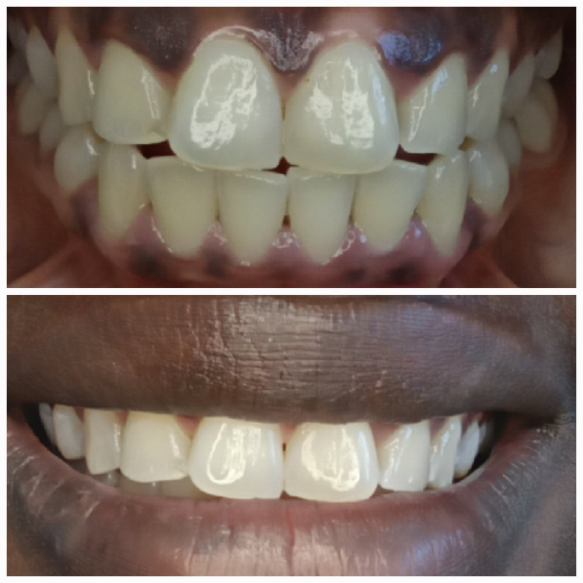 AbqTeethWhite's tweet photo. In a single visit, professional teeth whitening can give you bright white teeth. Book today: https://t.co/kpdbRO21AO

#professionalteethwhitening #laserteethwhitening #teethwhitening #abqteethwhitening #Albuquerque https://t.co/Nm6sSGIrv1