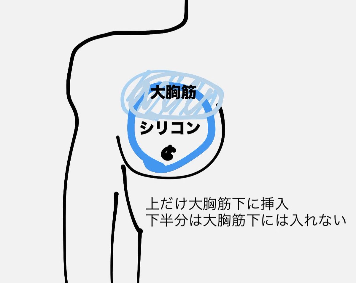 0726___MIOMIO's tweet photo. そもそもデュアルプレーン法って何？と思いお話聞いたところ、
大胸筋下にシリコンを全て挿入するのではなく上半分のみシリコンを挿入し下半分は入れないというやり方だそう。(全挿入だと手を動かした時横にズレるため)リップリングになりづらく、痩せ型に特に推奨してるとの事。
#豊胸 https://t.co/tnbHKu48UK
