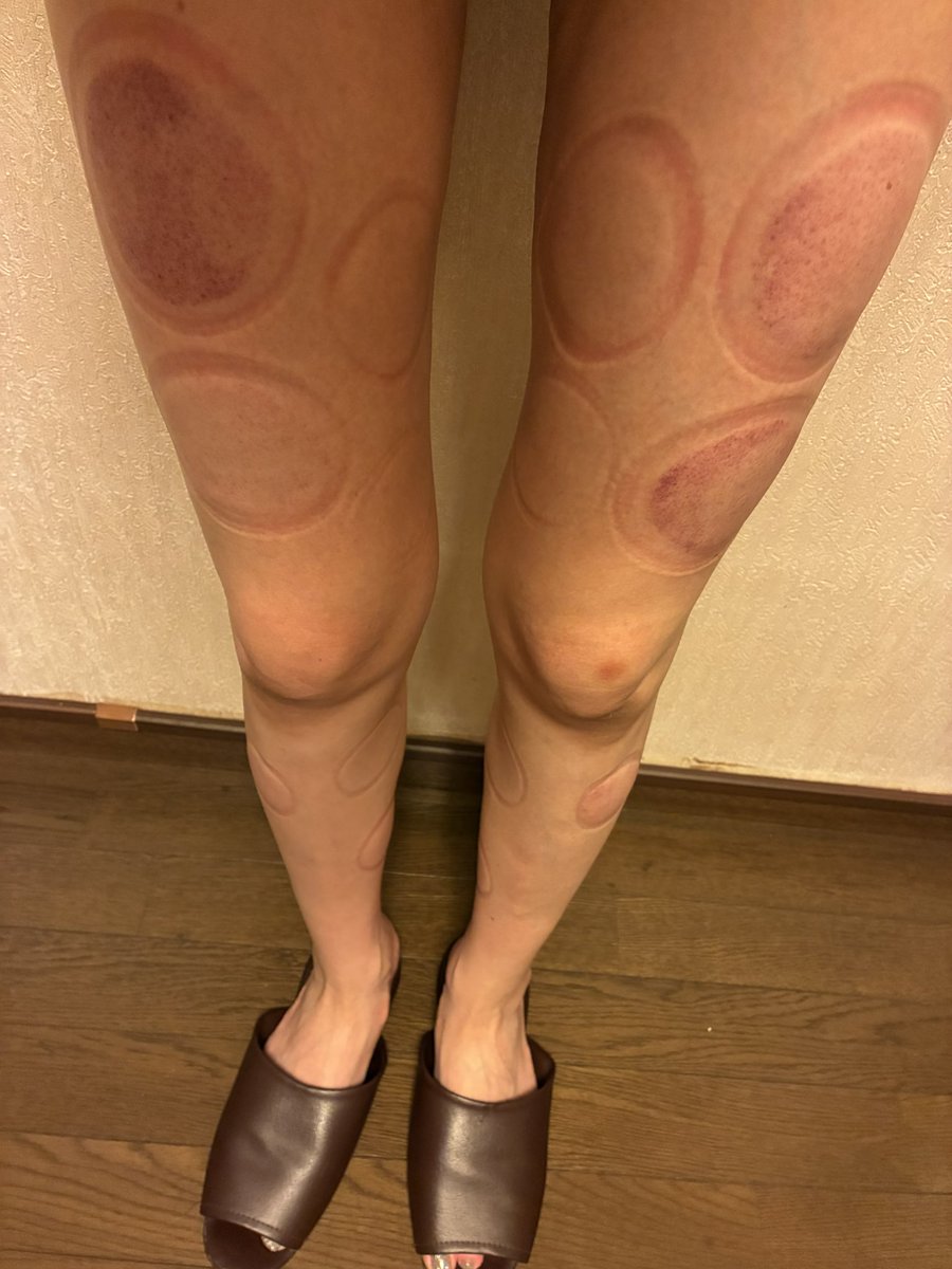 CM_type01's tweet photo. 坐骨神経痛が辛過ぎるので
今日は腰と脚を重点的にお願いしました💆♀️
宮城さんには16年お世話になっています✨✨
#カッピング
#鍼灸
#低周波
#vvB https://t.co/Dw41f7ALEJ