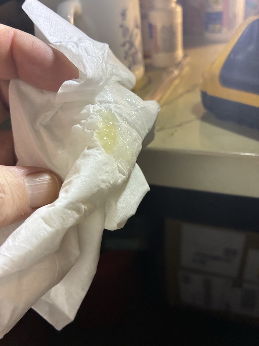 Awohali6's tweet photo. Its all back.  The infection n breathing problems both.  Started hittn  last week.  Im takn medicine.  Left leg isnt leaking fluid anymore n medicine the cardiologist gave me n recliner is helping with them swelling real bad like they was. https://t.co/Z4yAoci77i