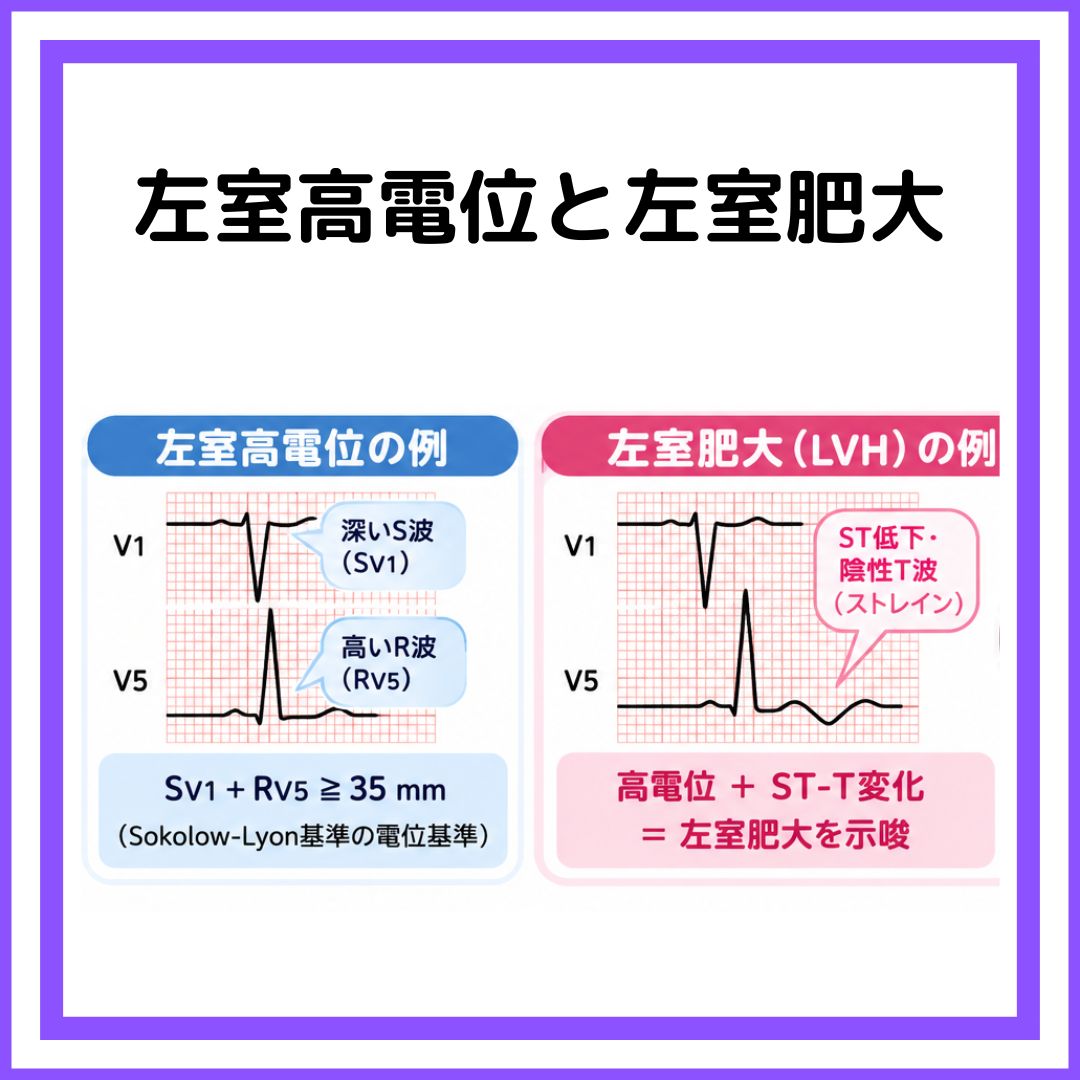 TrRja's tweet photo. 「LVH＝左室肥大」だけではない？🫀
心電図でよく目にする「LVH」。
一般的には Left Ventricular Hypertrophy（左室肥大） の略として使われますが
左室高電位 ＝ 左室肥大
ではありません
少なくとも
Sokolow-Lyon基準
📚SV1＋RV5（or RV6）≧35 mm
かつストレインパターンがあるかを覚えましょう https://t.co/KCLV6xXdjx