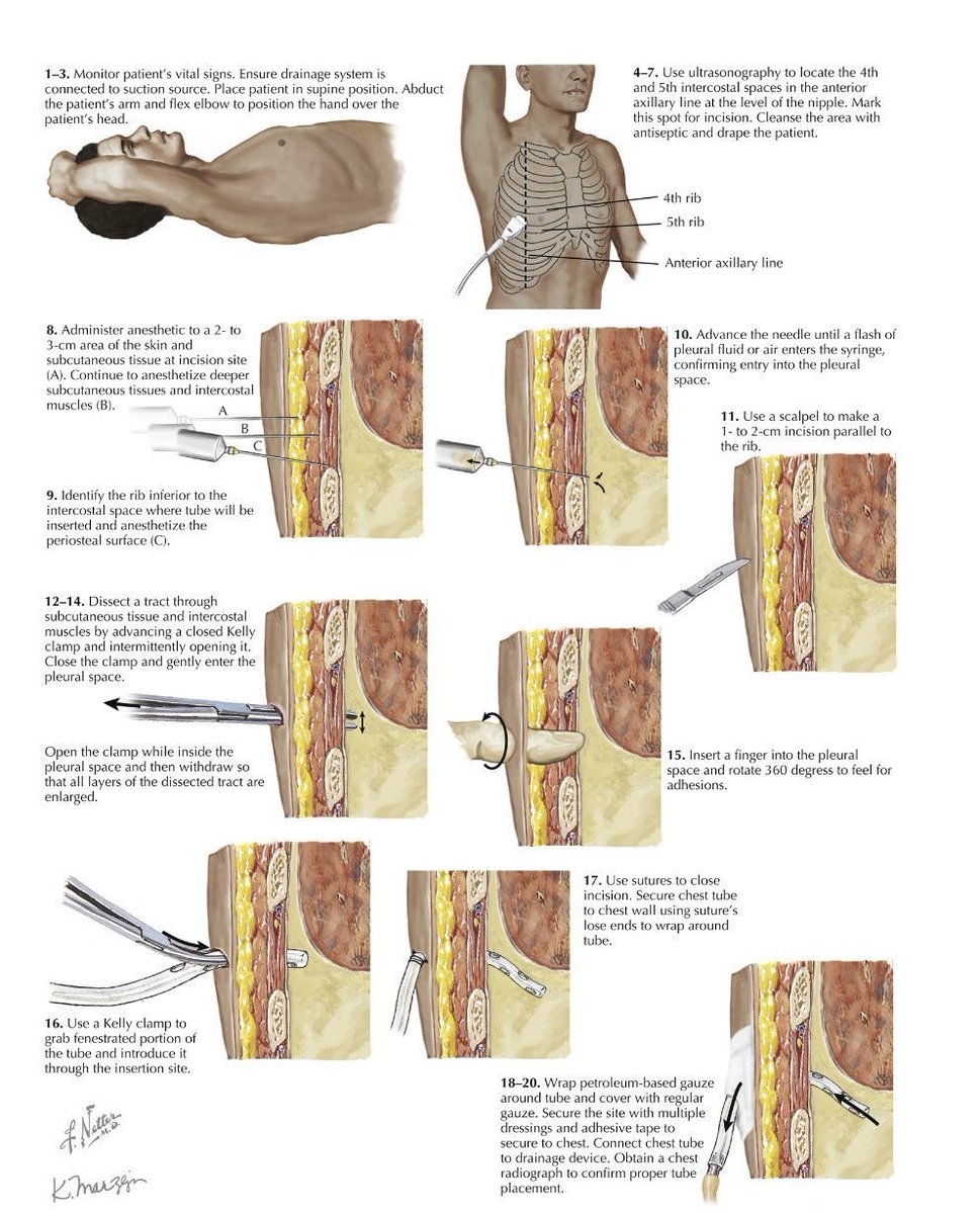 TrackYourHeart's tweet photo. Triangle of Safety for Chest Tube Insertion
It refers to the safe area for insertion of chest drain usually for management of pneumothorax or hemothorax.

The margins of triangle of safety are:
- lateral border of pectoralis muscle anteromedially
- horizontal line at the level of nipple making the base of the triangle
- anterior border of latissimus dorsi posteriorly