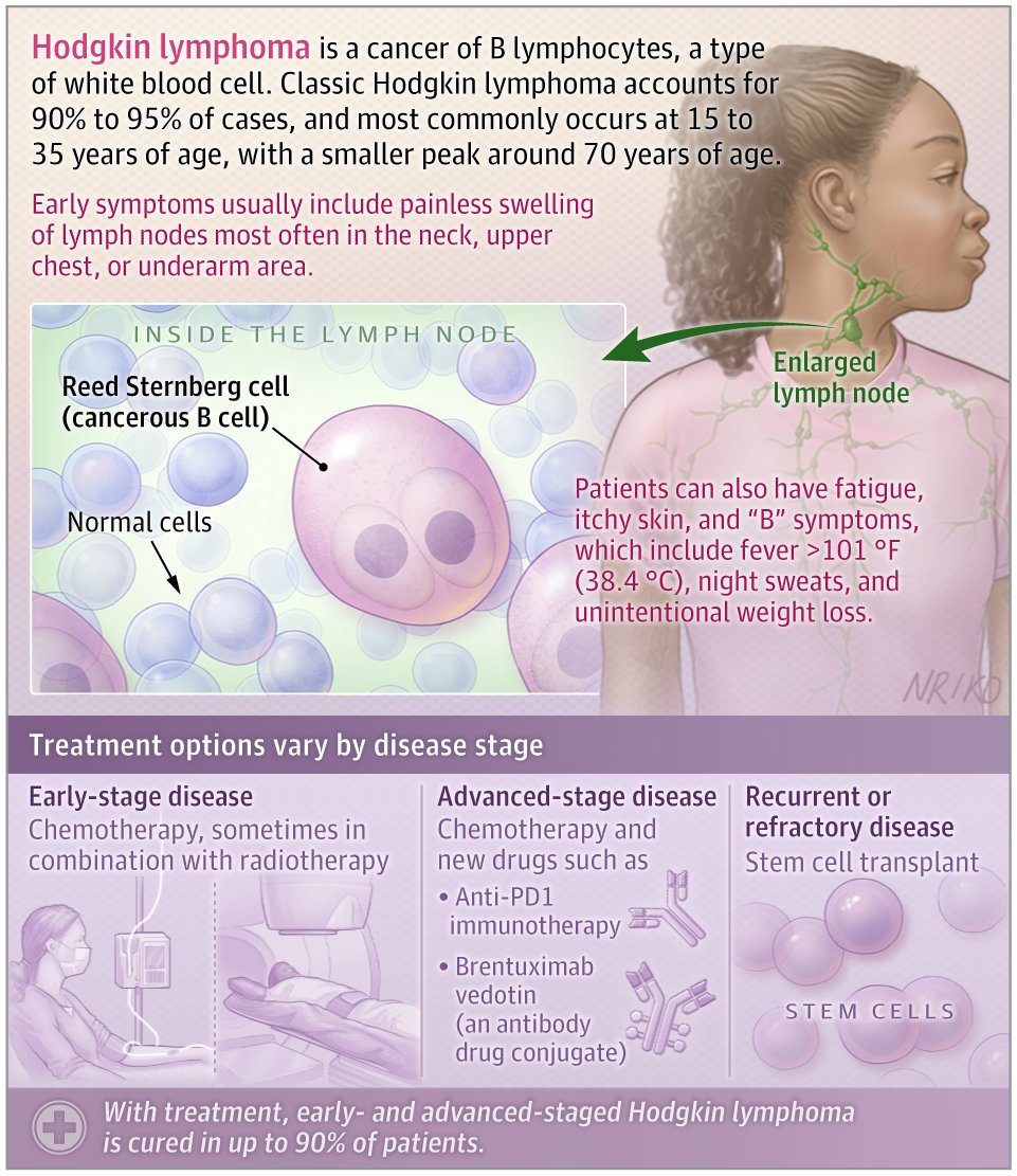 JAMA_current's tweet photo. 📝 #JAMAPatientPage: #HodgkinLymphoma is a cancer that arises from B lymphocytes, a type of white blood cell. 

This JAMA Patient Page describes risk factors, common symptoms such as painless lymph node swelling and B symptoms, and how classic Hodgkin lymphoma is diagnosed and staged.

https://t.co/E8piXnXjdk