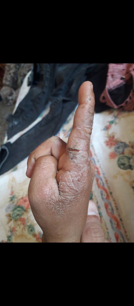 Maram_Gaza1992's tweet photo. 🚨💔 Please, don’t ignore my child.
#EczemaCrisis 😭
My little son is suffering from painful inflammation and a severe skin condition on his hand. His skin is cracking and peeling because of eczema, and the pain is getting worse every day. 💔
I urgently need $300 to pay for his treatment and medicine. I cannot afford it alone, and I am helplessly watching my child suffer without the care he needs. 😢
All of this is happening amid the war and the extremely harsh living conditions. The war has destroyed our home, safety, hygiene, access to food, and medical care.
🙏 Please help me raise $300 for my child’s treatment. Even a small donation can make a difference.
If you cannot donate, please share my pinned post. Please don’t let my voice disappear.
💔 Please… help me ease my child’s pain.
🇵🇸🍉 https://t.co/LukVFOfqIT