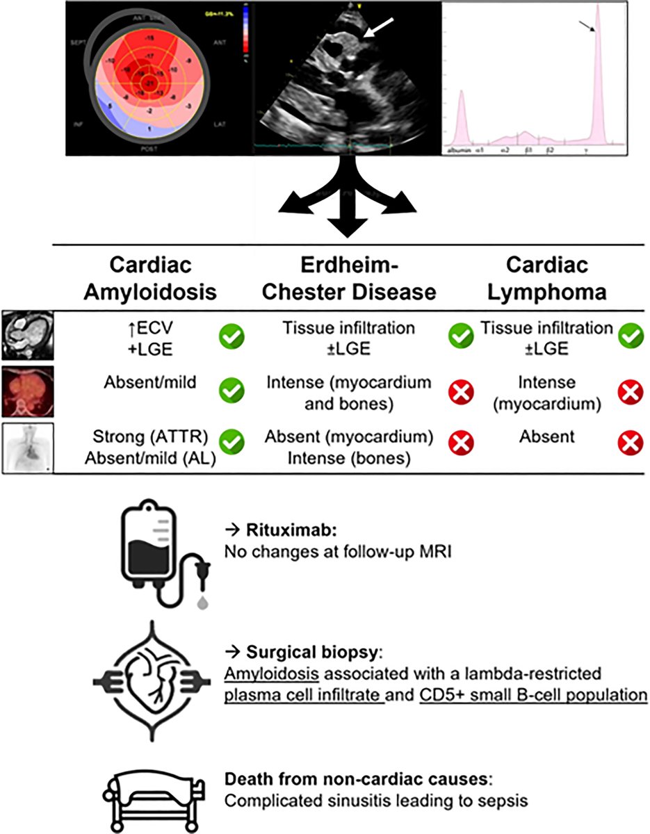 JACCJournals's tweet photo. Rare epicardial amyloidoma mimicked malignant cardiac infiltration in a new #JACCCaseReports case, highlighting diagnostic challenges in atypical AL #amyloidosis and the need for early hematologic evaluation and histopathologic confirmation. https://t.co/8huz3b67j0 #CardioOnc https://t.co/79t3zkIr6l