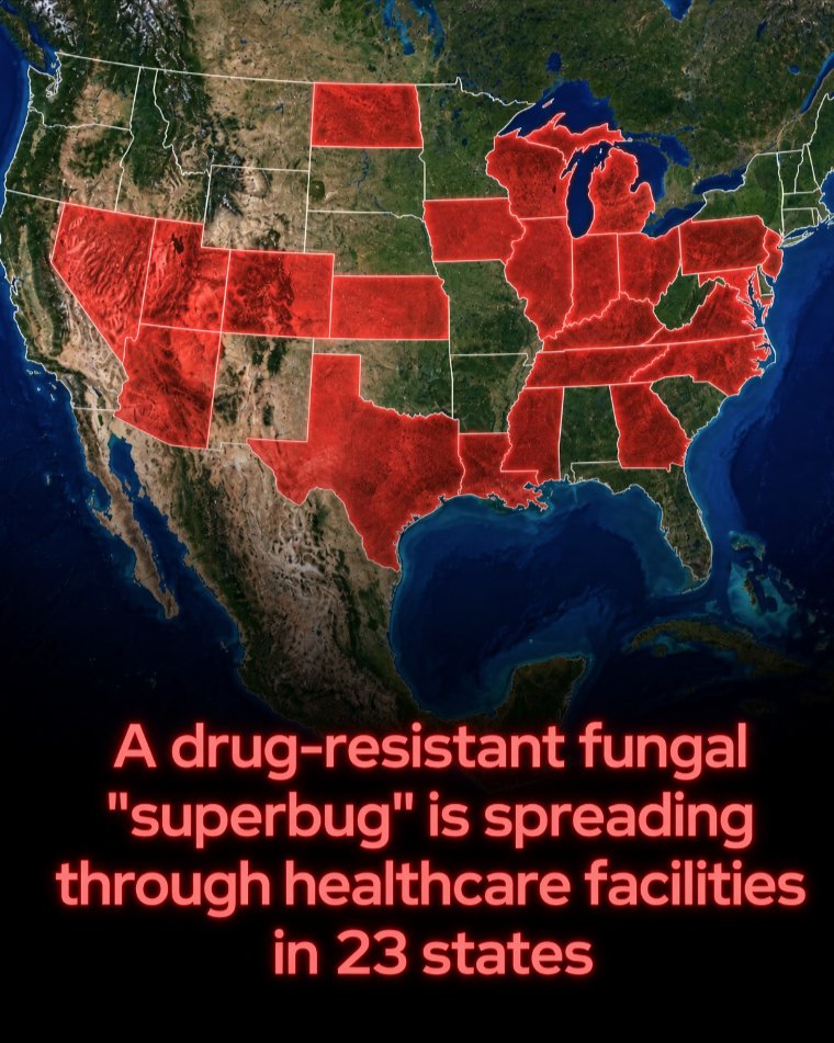 Rainmaker1973's tweet photo. A multidrug-resistant yeast is spreading in 23 states.

Candida auris is a yeast that can cause severe, sometimes fatal infections, especially in patients who are already seriously ill.

CDC screening data recorded 3,130 cases across 23 states. Those were screening detections of people carrying the fungus, rather than a count of active infections. The figure also does not cover every state where Candida auris has been found.

Carrying the fungus without symptoms is called colonization. It can stay on a patient’s skin or other body sites for a long time, spreading onto bedrails, furniture and shared medical equipment. From there, it can reach other patients.

People needing complex medical care are especially at risk. Catheters and breathing or feeding tubes can give the fungus routes into the body. Healthy people generally face a low risk of becoming ill.

Drug resistance makes some infections hard to treat. Most can still be treated with antifungal medicines called echinocandins, but some strains resist all three major antifungal drug classes.

A positive screening result alone does not mean someone needs medication. The CDC recommends treating clinical infections, not colonization without signs or symptoms of infection.

However, both infected and colonized patients need proper infection-control precautions. Healthcare facilities can cut transmission through screening, hand hygiene, protective clothing and disinfectants that work against Candida auris. Shared equipment needs careful cleaning between patients.

Patients can remain colonized even after an infection has been treated, making communication between facilities essential.

Patients and families should follow staff precautions, clean their hands and tell healthcare providers about previous positive Candida auris tests.