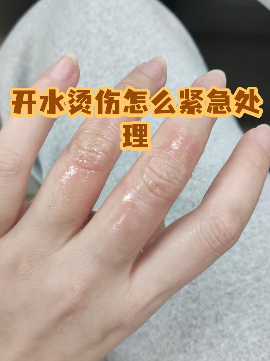 mtn213591's tweet photo. [I got accidentally烙沃肿奄 by hot iron at work, ouch! Need a cold compress now.]， https://t.co/Xpu52UBeyP