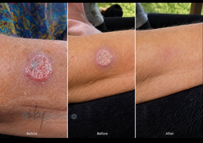 DrDavidivw's tweet photo. "I'll never forget her voice."
She called me trembling.

"There's a spot on my arm. The doctor says it's cancer. They want to cut it out – but I'm scared."

She sent me photos. Right arm, just below the elbow. A red, crusty, irregular lesion. Bleeding a little. Growing.

She'd already tried two treatments – a cream and a freezing session. Both failed. The spot came back worse.

Her doctor was pushing surgery. She was terrified.

I reviewed all her scans and medical records carefully.
It was basal cell carcinoma – not the most aggressive type, but stubborn. Persistent.

I told her: "If you're not ready for surgery, there's another option. It's worth a try."

I recommended Ivermectin cream – applied twice daily, just a tiny amount on the spot.

She started it right away.
Day 3: Nothing much. She was skeptical.

Day 5: The redness started fading.

Day 10: The lesion began drying up. A crust formed.

Day 18: The crust fell off. Pink, healthy skin underneath.

Day 21: The spot was completely gone.

She sent me new photos. I couldn't believe it. It was like it was never there.

She went back to her doctor.
He examined her arm and said: "This is remarkable. How did this happen?"

She said: "I tried something different."

He didn't ask what. I think he didn't want to know. Because if he had to admit that a simple, cheap cream worked – he'd have to explain why he never offered it.

The heart of this story:
One woman. Skin cancer on her arm. Surgery was the only option she was given.

She reached out. We tried Ivermectin cream.

Three weeks later – her skin was clear.

Follow for more info.