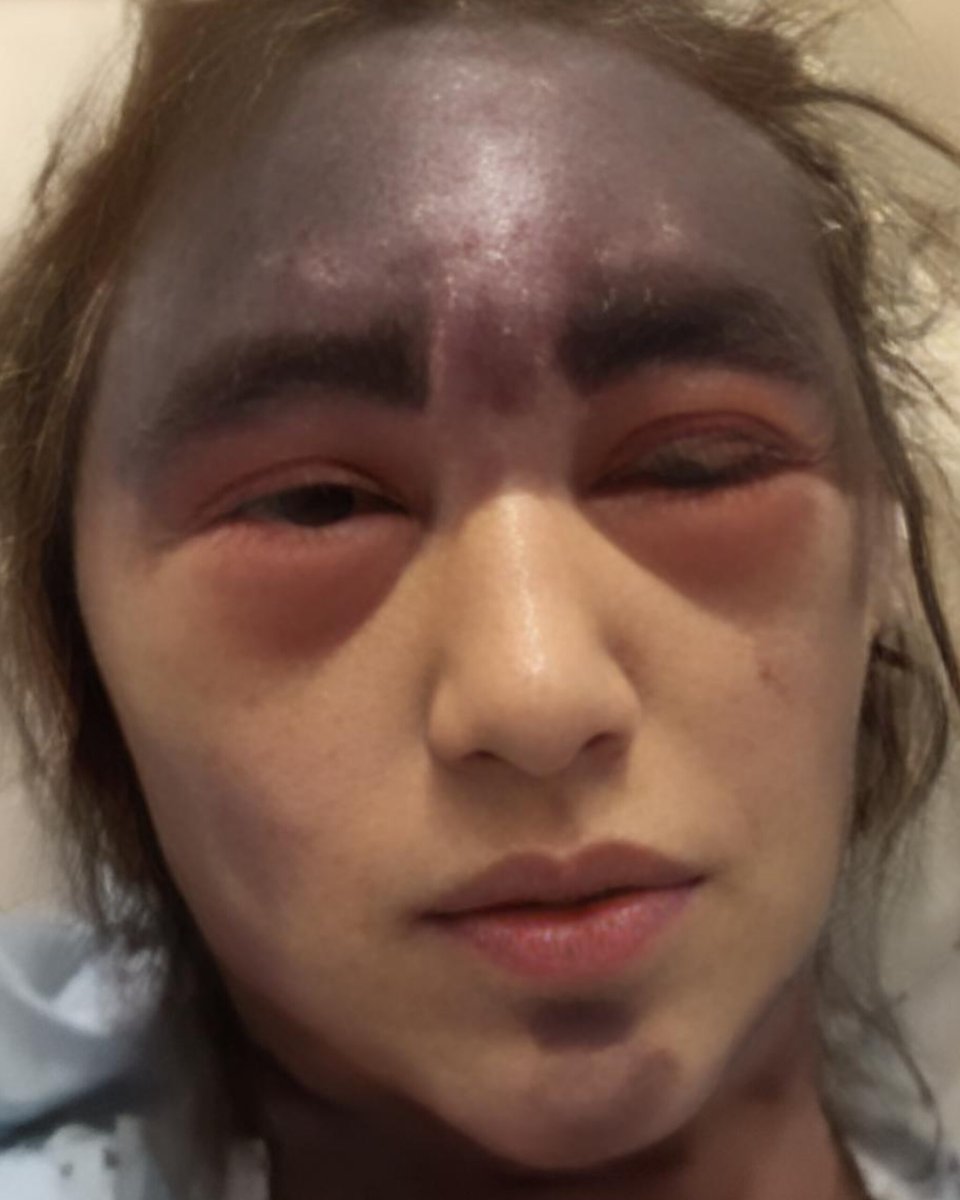 DavidJHarrisJr's tweet photo. 🚨WOW: 23-year-old Alexis Lorenze goes viral on social media after suffering a severe medical crisis following hospital vaccinations!

In September 2024, 23-year-old Alexis Lorenze sparked massive online debate after posting heartbreaking videos from her hospital bed, showing severe facial swelling, extreme bruising, and dark purple lesions across her body.

Lorenze was admitted to UCI Medical Center in Orange, California, to seek treatment for Paroxysmal Nocturnal Hemoglobinuria (PNH)—a rare, life-threatening blood disorder that causes the immune system to break down red blood cells. 

Because standard PNH targeted treatments (like complement inhibitors) suppress specific parts of the immune system and increase susceptibility to severe infections, standard medical protocols require patients to receive vaccinations—including meningitis and pneumonia shots—prior to or alongside therapy. 

Lorenze, who had previously abstained from vaccines for religious reasons, alleged that hospital staff required her to receive three vaccines simultaneously before proceeding with her full treatment plan. Within minutes of receiving the shots, her health rapidly deteriorated, leading to severe reactions, widespread purpura/bruising, and temporary loss of vision.

The controversy ignited fierce debate across social media:
• Family & Supporters: Alleged the hospital overwhelmed her fragile immune system by administering multiple shots at once to a critically ill PNH patient, sparking public calls for accountability.
• Medical Experts & Fact-Checkers: Pointed out that PNH itself triggers severe blood clotting, hemolytic crises, and skin lesions—especially during flare-ups. Medical professionals noted that while vaccinations or underlying infections can trigger a severe PNH flare-up, her underlying blood disorder was the primary driver of her life-threatening symptoms.

Lorenze and her family used social media to document her fight, demand medical answers, and ask followers to share her story to raise awareness about patient rights and rare blood disorders!