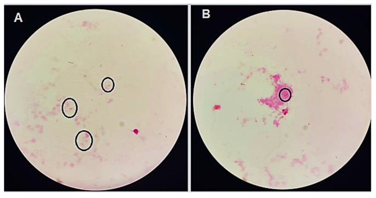 Osteology_MDPI's tweet photo. 🦠New Research in #Osteology!
Prosthetic Hip Infection Secondary to Morganella morganii: A Rare, Morbid Condition
📚Read the article:
🔗https://t.co/nMwRWqBKQs
#Orthopedics #HipReplacement #PeriprostheticJointInfection #InfectiousDiseases #BoneHealth #ClinicalResearch https://t.co/jAz0tfi4wp