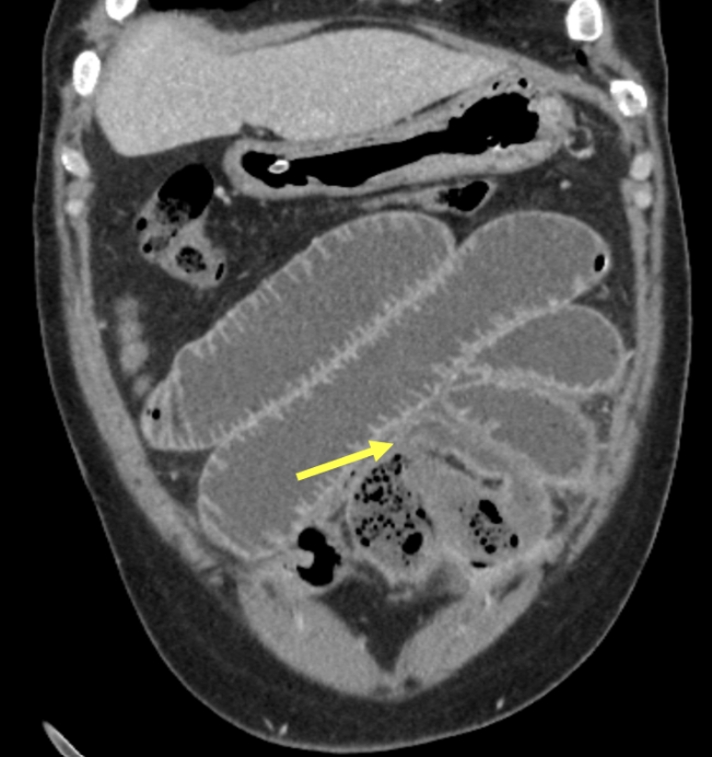 DonatelloXPro's tweet photo. HIS BOWEL WAS DYING FROM THE INSIDE

And at first, it looked like an obstruction

A 50-year-old man with diabetes, coronary artery disease and a long smoking history came in after 8–10 days of abdominal pain, vomiting and constipation

Ultrasound suggested small bowel obstruction

CT angiography showed something far more dangerous

A clot was blocking the superior mesenteric artery about 5 cm from its origin

Beyond the blockage, the terminal branches no longer filled with contrast

Long segments of small bowel showed severely reduced blood flow

Some areas stopped enhancing completely

Then CT found the complication

The bowel wall had already broken down

Small pockets of air and bowel contents were trapped in the mesentery

A contained perforation

There was no massive free air

No portal venous gas

No obvious pneumatosis

But the bowel was already necrotic

Surgery confirmed transmural necrosis and perforation

The dead segment was removed and an ileostomy was created

The first clue looked mechanical

The real emergency was vascular

1543 ↔ now