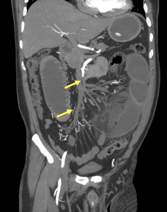 DonatelloXPro's tweet photo. HIS BOWEL WAS DYING FROM THE INSIDE

And at first, it looked like an obstruction

A 50-year-old man with diabetes, coronary artery disease and a long smoking history came in after 8–10 days of abdominal pain, vomiting and constipation

Ultrasound suggested small bowel obstruction

CT angiography showed something far more dangerous

A clot was blocking the superior mesenteric artery about 5 cm from its origin

Beyond the blockage, the terminal branches no longer filled with contrast

Long segments of small bowel showed severely reduced blood flow

Some areas stopped enhancing completely

Then CT found the complication

The bowel wall had already broken down

Small pockets of air and bowel contents were trapped in the mesentery

A contained perforation

There was no massive free air

No portal venous gas

No obvious pneumatosis

But the bowel was already necrotic

Surgery confirmed transmural necrosis and perforation

The dead segment was removed and an ileostomy was created

The first clue looked mechanical

The real emergency was vascular

1543 ↔ now