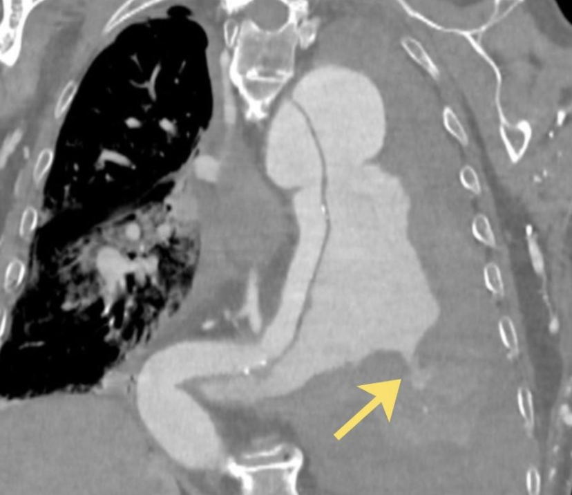 DonatelloXPro's tweet photo. HIS AORTA RUPTURED INTO HIS LUNG

Then he started coughing up blood

An 84-year-old man with a history of complex aortic disease came to the ER with sudden haemoptysis and rapid respiratory and haemodynamic deterioration

CT angiography showed the source

A chronic type B aortic dissection extended through the descending thoracic aorta

At the mid-descending aorta, the false lumen had ruptured

Arterial contrast was leaking directly into the adjacent left lower lung

There was also a partially thrombosed pseudoaneurysm measuring about 69 × 59 mm

The left lower lobe and lingula were nearly collapsed

Ground-glass opacities and pleural effusions surrounded the damage

The diagnosis was an aortopulmonary fistula

A rare and catastrophic communication between the aorta and lung

Surgery or endovascular repair can sometimes be attempted

In this case, the anatomy and operative risk left no viable intervention

Imaging guided a palliative approach

The blood in his airway wasn't coming from the lung itself

It was coming from the aorta

1543 ↔ now