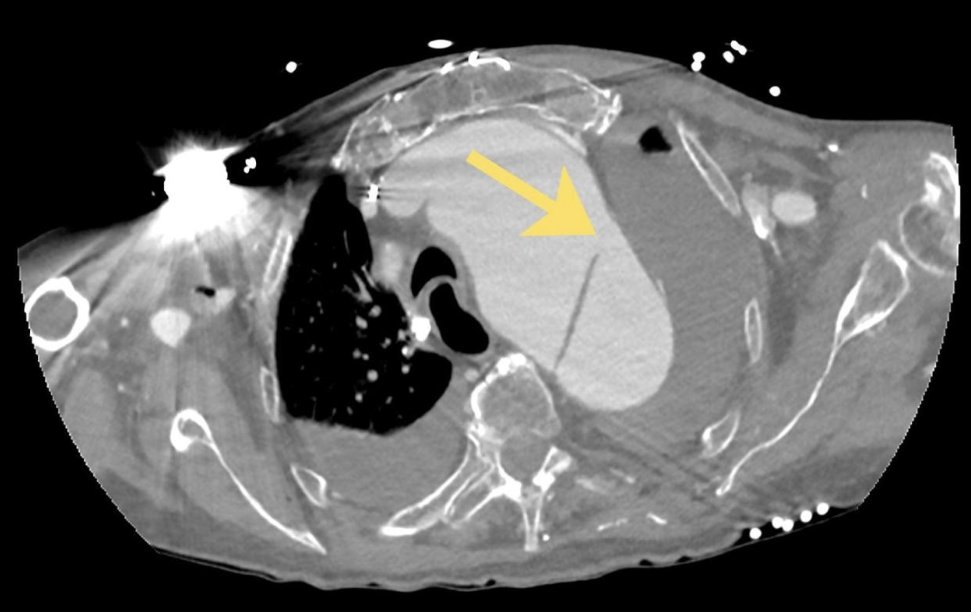 DonatelloXPro's tweet photo. HIS AORTA RUPTURED INTO HIS LUNG

Then he started coughing up blood

An 84-year-old man with a history of complex aortic disease came to the ER with sudden haemoptysis and rapid respiratory and haemodynamic deterioration

CT angiography showed the source

A chronic type B aortic dissection extended through the descending thoracic aorta

At the mid-descending aorta, the false lumen had ruptured

Arterial contrast was leaking directly into the adjacent left lower lung

There was also a partially thrombosed pseudoaneurysm measuring about 69 × 59 mm

The left lower lobe and lingula were nearly collapsed

Ground-glass opacities and pleural effusions surrounded the damage

The diagnosis was an aortopulmonary fistula

A rare and catastrophic communication between the aorta and lung

Surgery or endovascular repair can sometimes be attempted

In this case, the anatomy and operative risk left no viable intervention

Imaging guided a palliative approach

The blood in his airway wasn't coming from the lung itself

It was coming from the aorta

1543 ↔ now