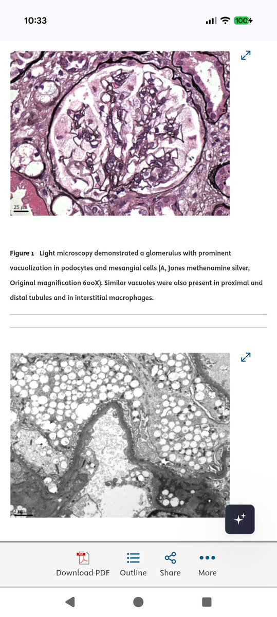 grace_choung's tweet photo. Podocyte and Tubular Vacuolization in Patients Receiving Pegcetacoplan - Kidney International

#renalpath https://t.co/GCfYiu3yzK https://t.co/CKC7L6Ipva