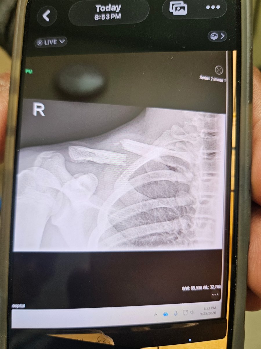 izaak10753471's tweet photo. Thorp 26 Owen 36 
6 carries 90 yards (15 ypc)
Beginning of 2nd quarter got tackled by 3 guys and landed at a bad angle and broke my collarbone. Season ending injury. Small step backwards but will be stronger and more determined next year. Thank you everyone. https://t.co/dD0ju7LTFH