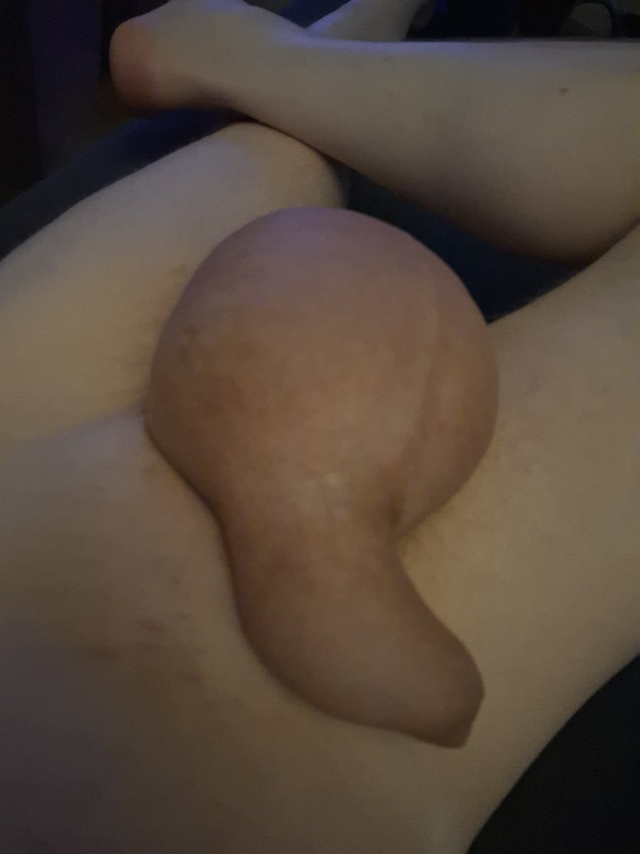RickSalBalls's tweet photo. Hmmn feeling great.
#salineinfusion #salineballs #monsterbulge #saline_infusion #hugeballs #scrotalinfusion #hugebulge #giantballs #salinecock https://t.co/MChyXeeLdJ