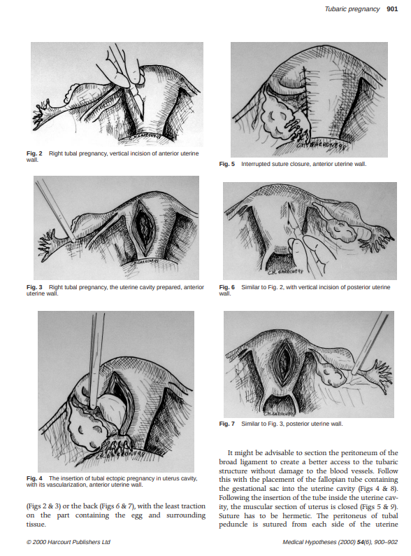 MarkProffitt's tweet photo. Example of how to innovate. Desire: save life of mother & baby. Breakdown task to satisfy each result. Use known resources. Basic surgery, uterus, developed vascularization. By the way, this has been done successfully. #medical #pregnancy #ectopic #abortion #innovation https://t.co/fHak3rLdgO