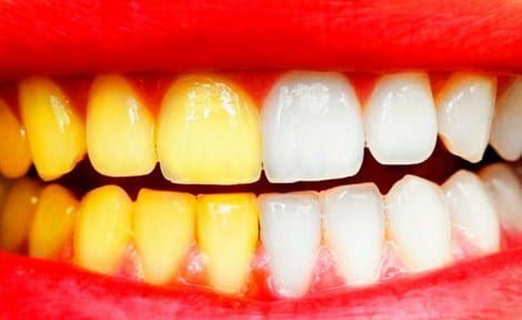 yajnshri's tweet photo. Whiten your teeth without harming them

This method helps with almost any gum disease while whitening teeth almost instantly, dissolving tartar and healing small wounds in the mouth.

Ingredients

- 0.5 tsp. baking soda add.
- 10-20 drops of hydrogen peroxide (pharmacy)
- a few drops of lemon.

In the baking soda add hydrogen peroxide and lemon juice. Paste is ready! Dip a cotton ball in the paste and rub the paste on the teeth and gums from the outside and inside.

The lemon neutralizes the baking soda and adds freshness, the baking soda cleans plaque from your teeth, and the peroxide disinfects and whitens.

❌ You should not rinse your mouth, eat, or drink for 15 minutes after brushing your teeth this way.