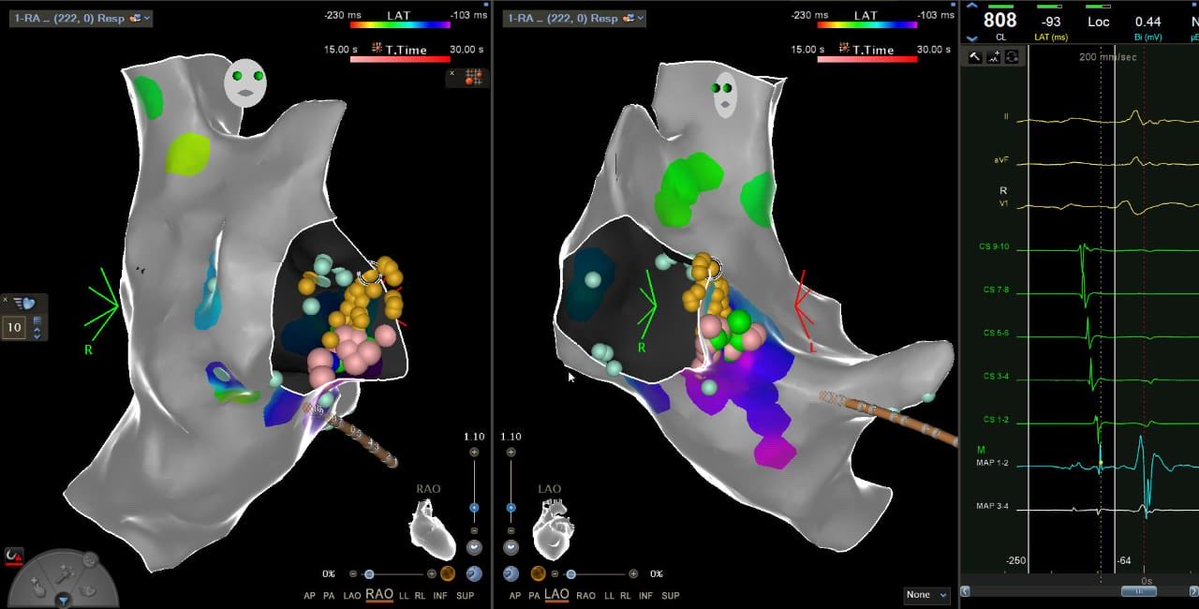 dr_avishkar's tweet photo. Zero-fluoroscopy ablation. ⚡️

Anatomy + intracardiac electrograms + 3D mapping — no fluoroscopy.

Building a workflow where electrophysiology guides every step.

#EP #Electrophysiology #EPEEP #CatheterAblation #Cardiology https://t.co/mnvGSwgUEu