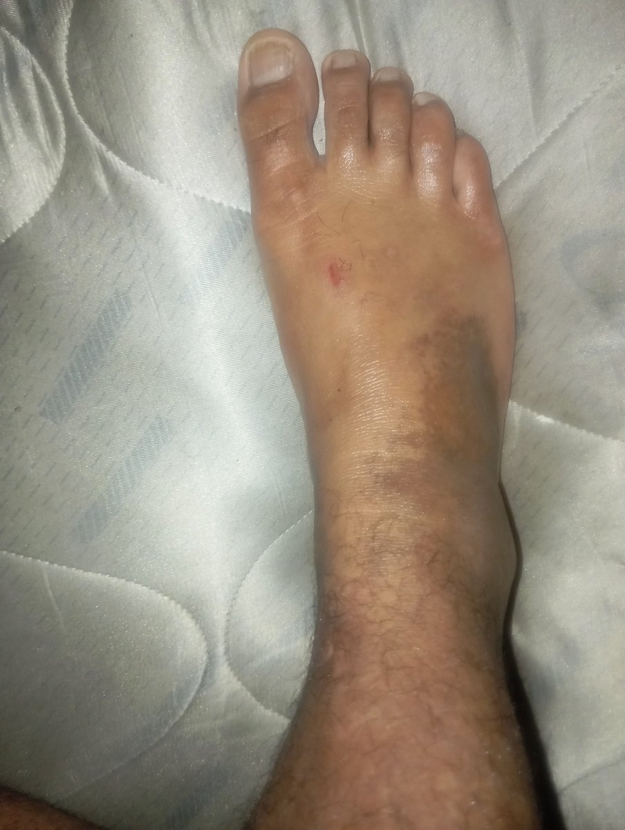 joelcorvera03's tweet photo. Hoy asistí a Unidad Médica Del Isss Prados de Venecia por un trauma directo en mi pie derecho. Me cayó un ventilador encima, tengo un hematoma grande en el empeine, no puedo estar de pie ni caminar y me duele al mover los dedos.

@isss_gob_sv https://t.co/XU0Rr5vsxT