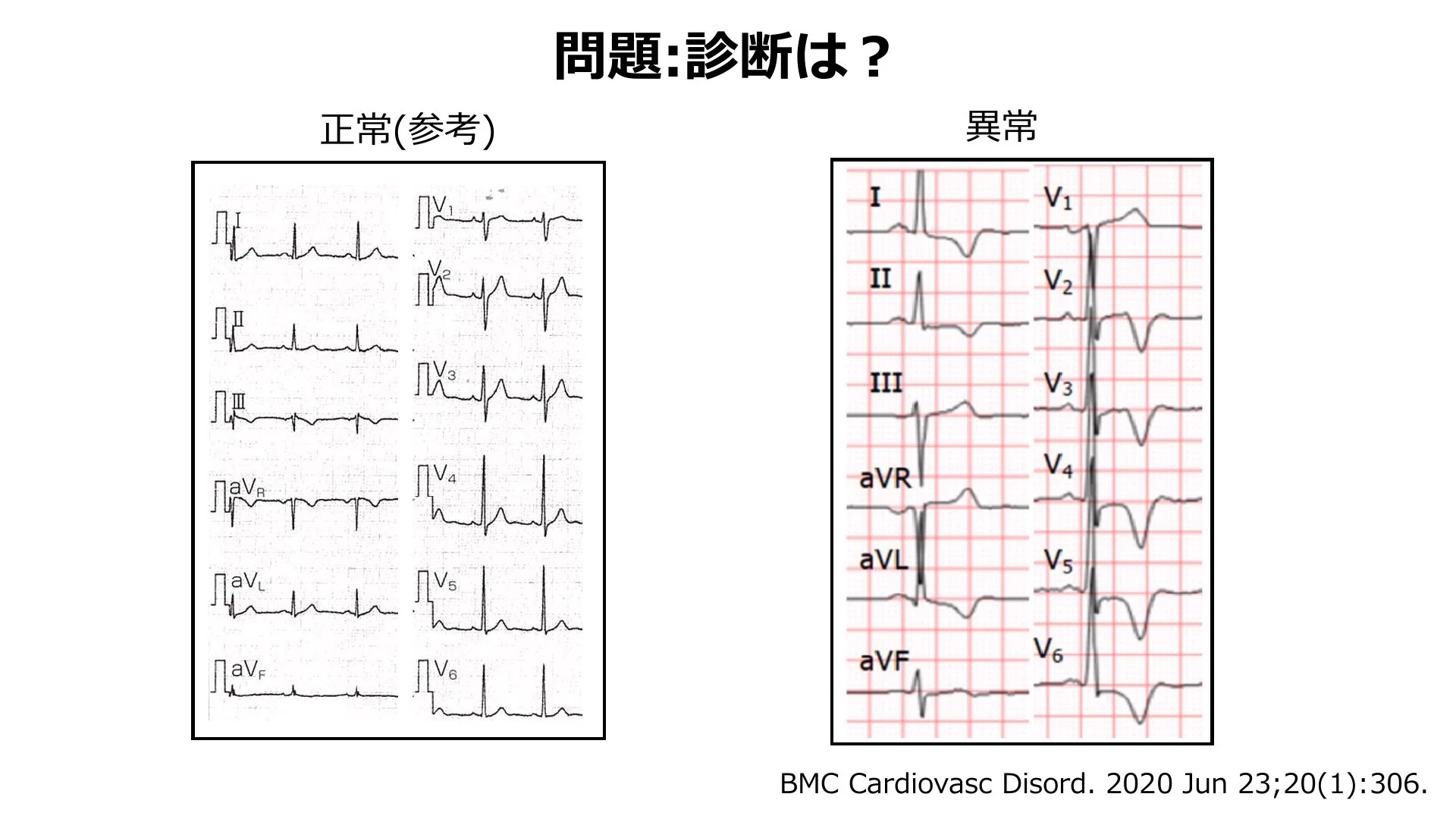 不整脈心電図の読解トレーニング 不整脈心電図の読解トレーニング