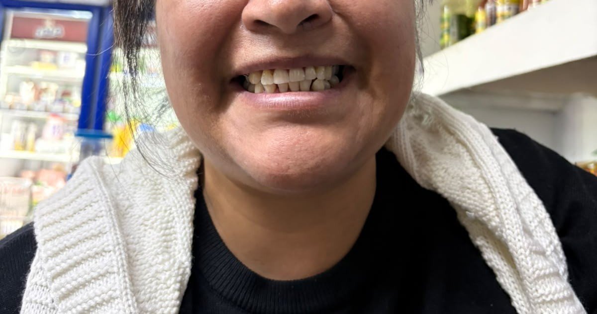 EdwinGo96935815's tweet photo. Primer caso documentado aqui en twitter, orgulloso del trabajo realizado
#odontologia #odonto #MCD #dentista #universidad #protesis #extraccióndental https://t.co/op1hQhupFi