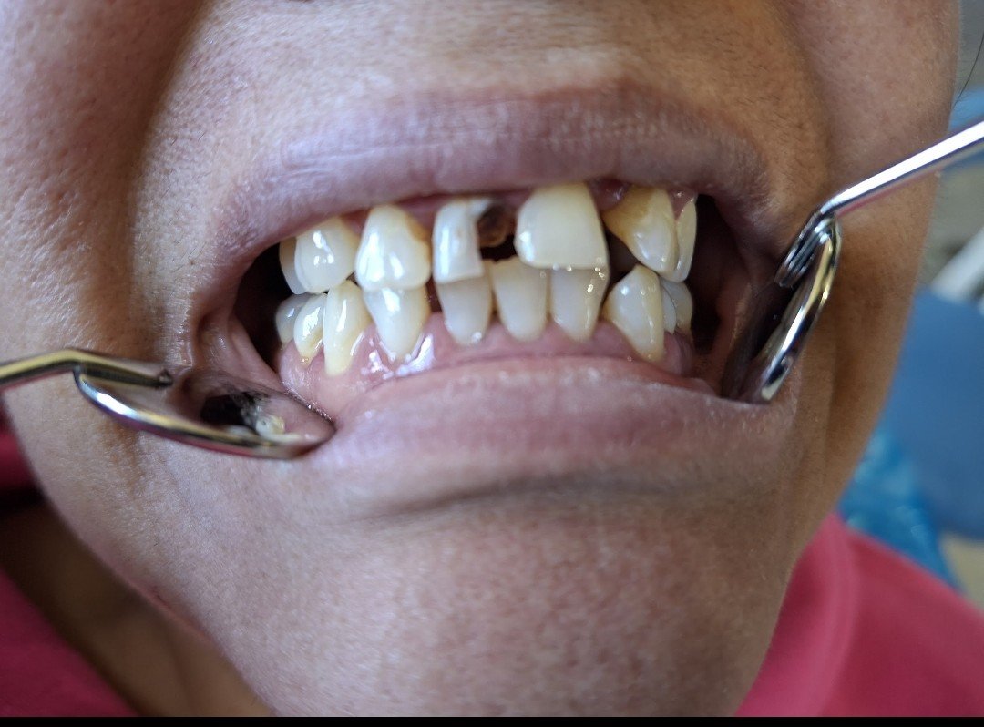 EdwinGo96935815's tweet photo. Primer caso documentado aqui en twitter, orgulloso del trabajo realizado
#odontologia #odonto #MCD #dentista #universidad #protesis #extraccióndental https://t.co/op1hQhupFi