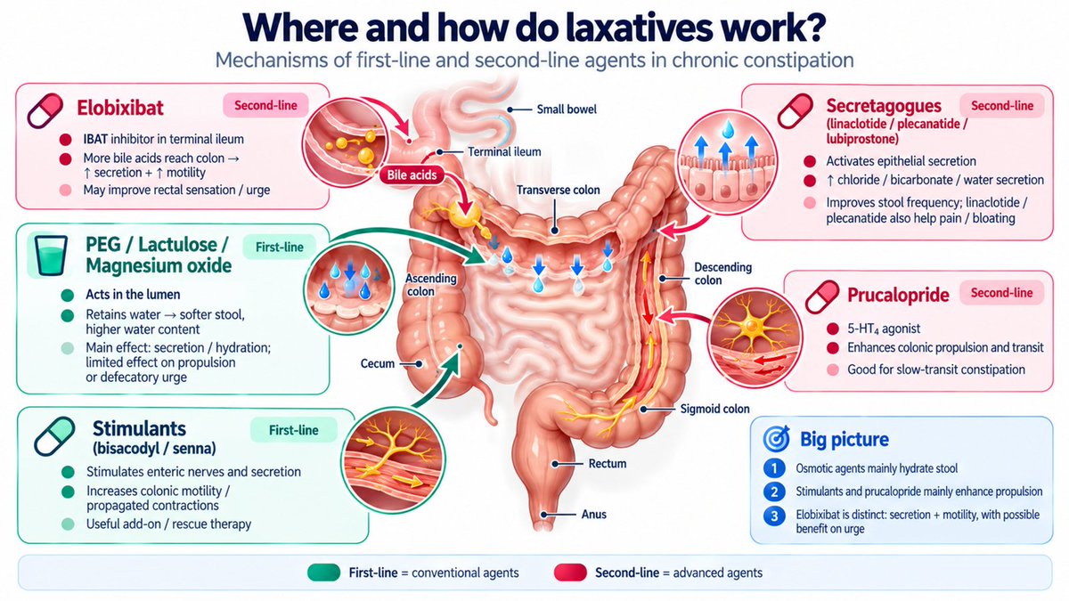 KewinSiah's tweet photo. Working on my WCOG 2026 #constipation slides — a reminder that good medicine isn’t just about the evidence, but making it easier to understand and use.
Got slightly derailed making a few infographics along the way 😊 #WCOG2026 #Gastroenterology #Gitwitter https://t.co/5INz2ycp5g