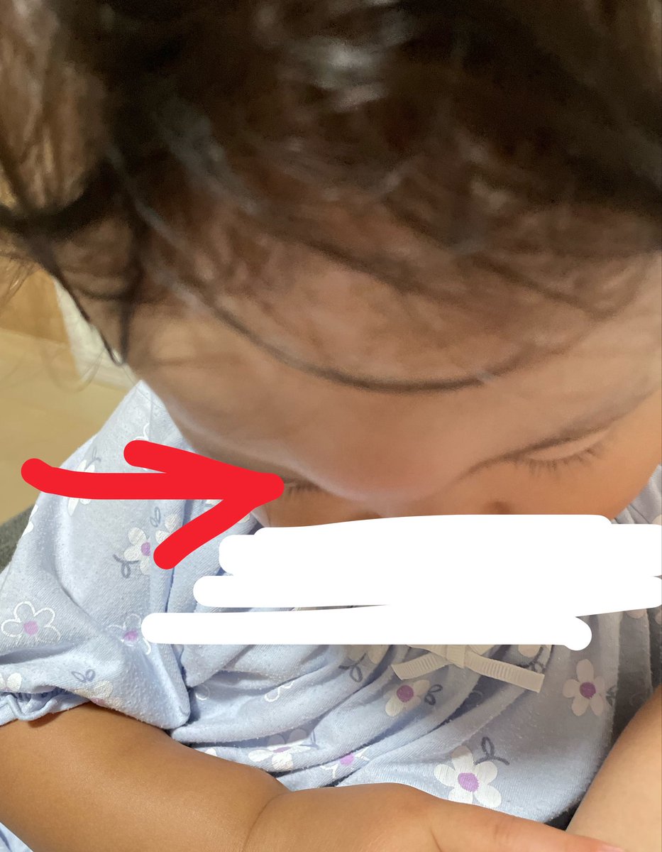 ask_kmama's tweet photo. 蚊に刺されたら腫れる体質の次女、おでこど真ん中を刺されてコブダイになってる😭許せん🦟 https://t.co/xfRY7t1zep