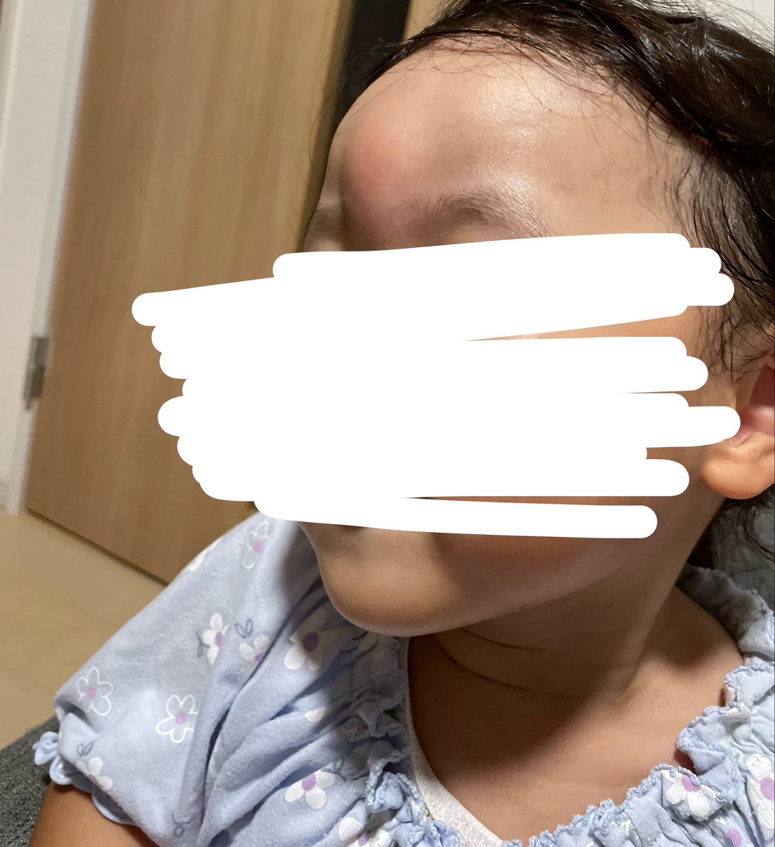 ask_kmama's tweet photo. 蚊に刺されたら腫れる体質の次女、おでこど真ん中を刺されてコブダイになってる😭許せん🦟 https://t.co/xfRY7t1zep